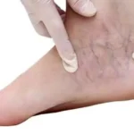 Ayak Bileği Çevresindeki Varislerin Sebepleri Nedir?