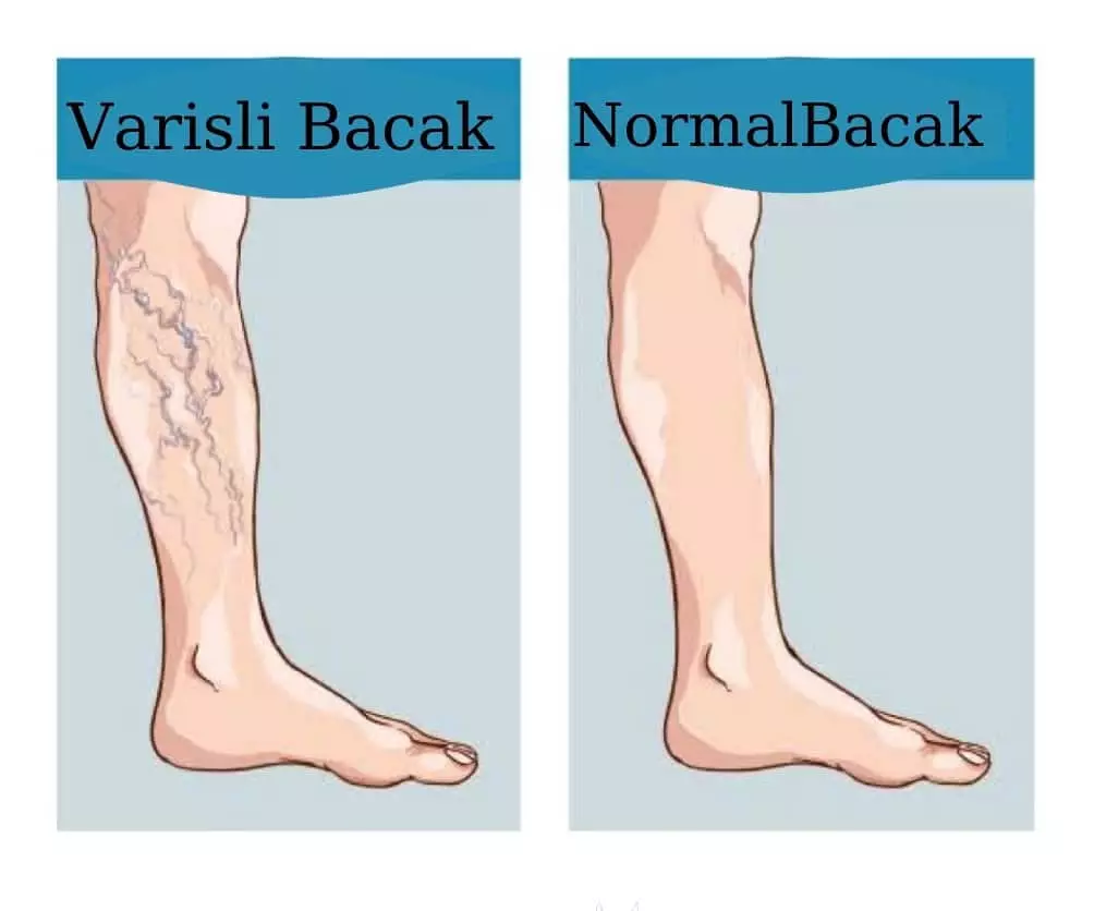 Varisli-bacak-normal-bacak.jpg