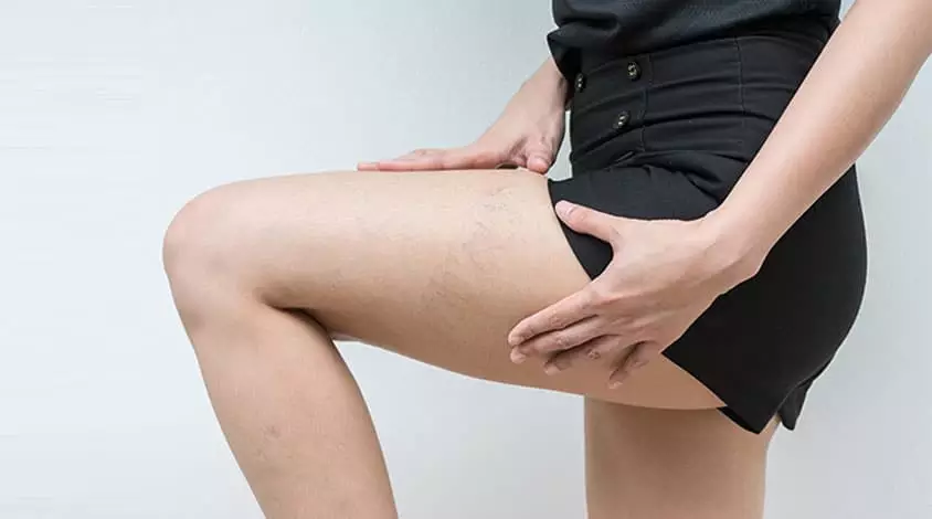 Varis Tedavisi Sonrası İyileşme Süreci ve Daha Fazlası