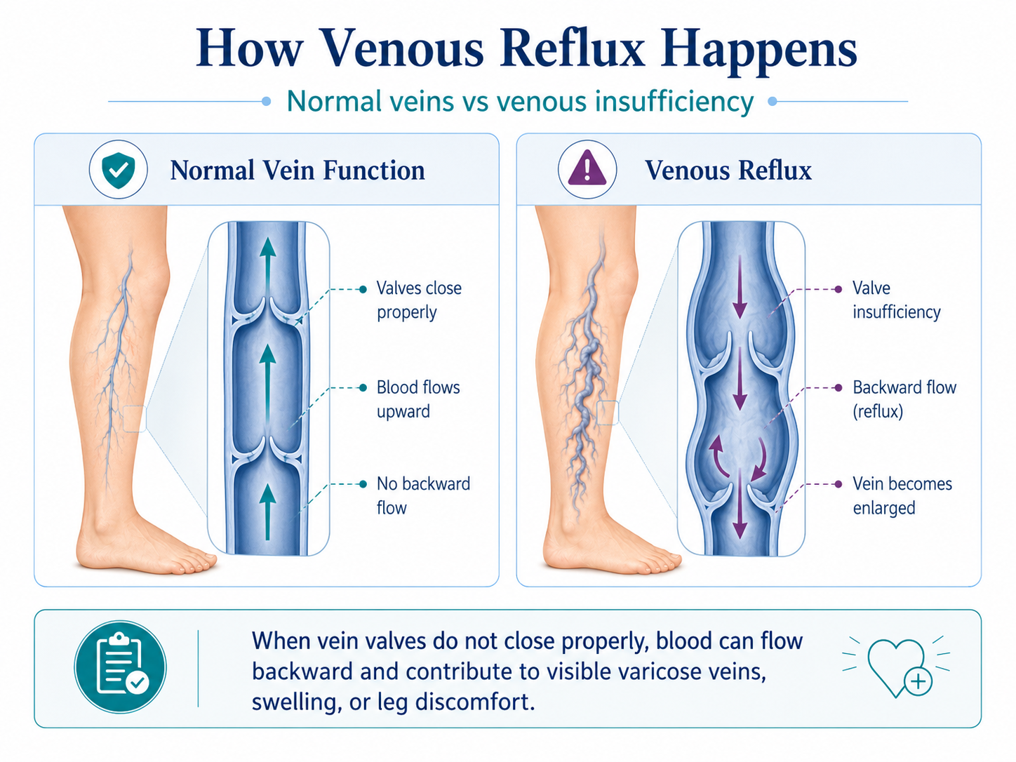 venous-reflux-explained